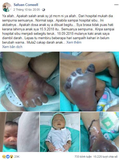 Lấy máu xét nghiệm nhiễm trùng máu, chân bé sơ sinh bị sưng phù, tím đen-1