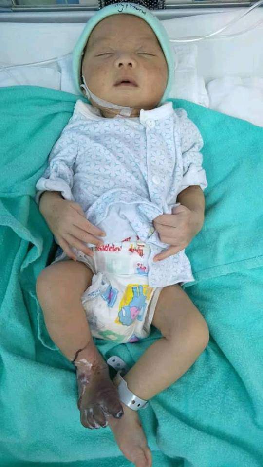 Lấy máu xét nghiệm nhiễm trùng máu, chân bé sơ sinh bị sưng phù, tím đen-2