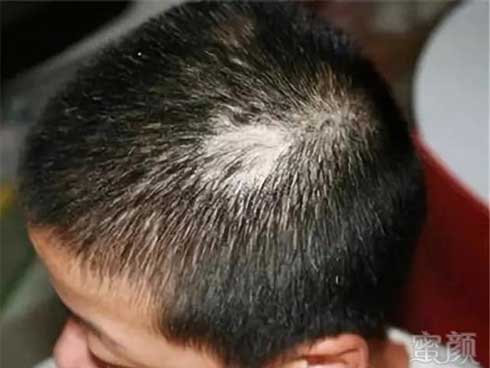 Con trai 3 tuổi đột nhiên bị rụng tóc, nguyên nhân thật sự khiến cha mẹ rất xấu hổ-1
