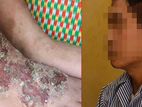 Thích ăn tiết canh, rau sống, nem chua, người đàn ông bị đau gan vì nguyên nhân không ngờ