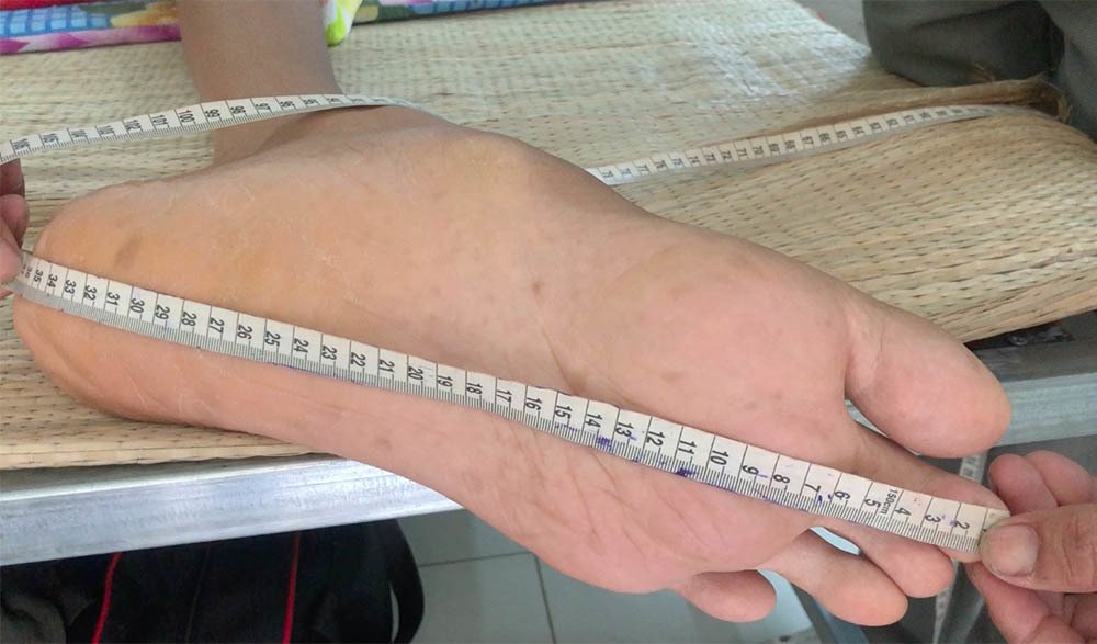 Nam thanh niên người Việt bất ngờ cao 2,5m sau đợt sốt kéo dài-3