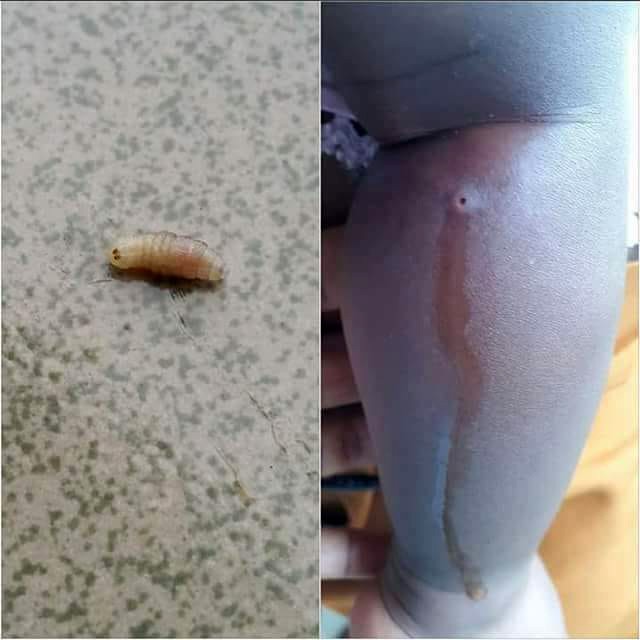 Nặn mủ từ vết sưng trên chân con, mẹ hoảng hồn phát hiện 4 con giòi sống chui ra-1