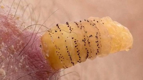 Nặn mủ từ vết sưng trên chân con, mẹ hoảng hồn phát hiện 4 con giòi sống chui ra-2