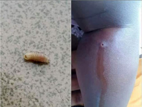 Nặn mủ từ vết sưng trên chân con, mẹ hoảng hồn phát hiện 4 con giòi sống chui ra