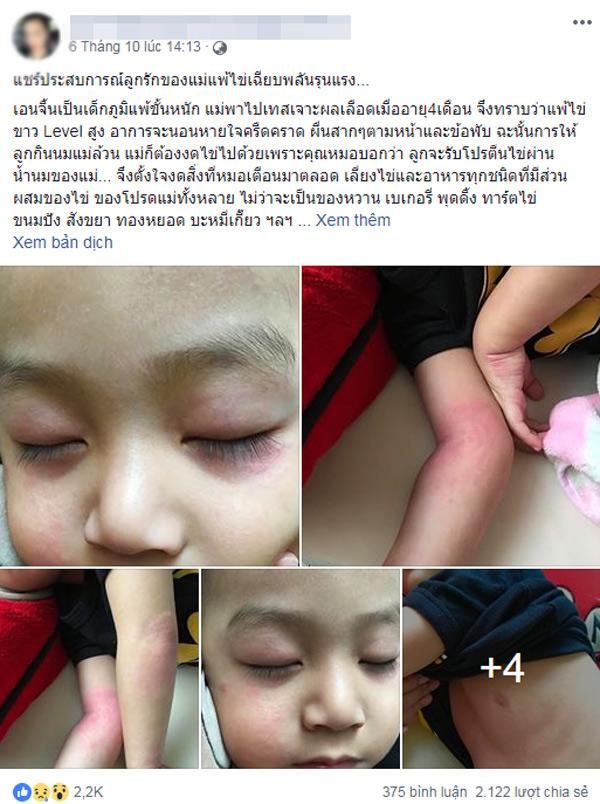 Con trai mẩn đỏ khắp người sau khi nghịch quả trứng, lời cảnh tình của bà mẹ gây giật mình-1