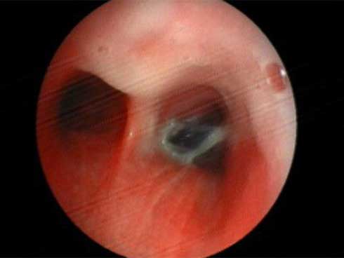 Hạt hồng xiêm kẹt trong đường thở người phụ nữ suốt 4 năm-1