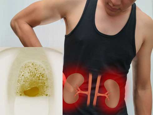 Chàng trai 32 tuổi đột nhiên bị suy thận cấp chỉ vì làm 2 việc trong thời gian dài-1