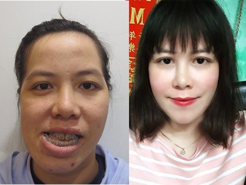 Niềm vui bất ngờ của cô giáo dạy nhạc từng bị biến dạng khuôn mặt