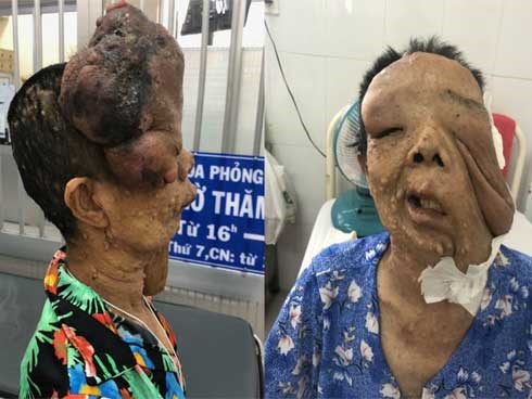 Người phụ nữ 10 năm không dám ra đường vì mang khuôn mặt kỳ dị