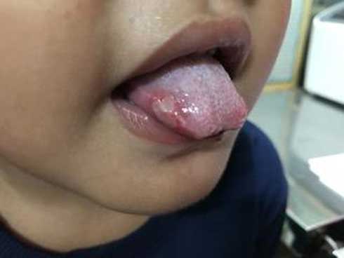 Mắc tay chân miệng, bé càng đau càng dễ biến chứng, cha mẹ cẩn thận khi con loét miệng-1