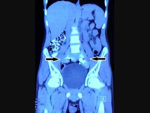 Chụp phim thấy 2 quả thận biến mất, chỉ còn 1… chiếc đĩa!-1