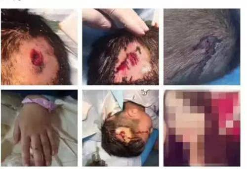 Bé 5 tuổi bị bạn gái của bố đập búa liên tiếp vào đầu nhưng không dám khóc, mách bố-1