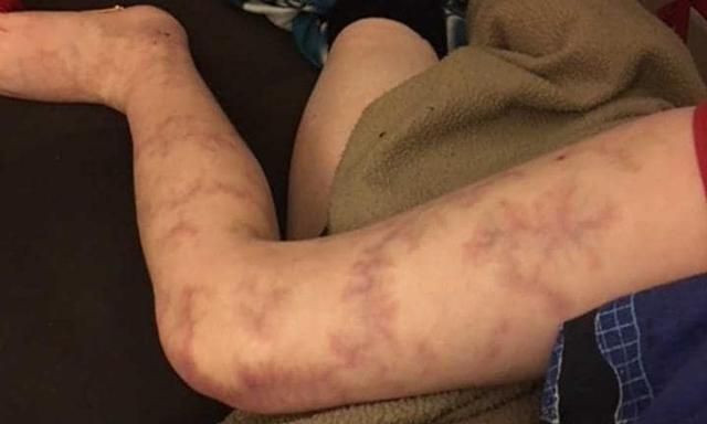 Chưa kịp mừng con ra đời, mẹ suýt ngất khi thấy chân con bầm tím như bị đánh đập-3