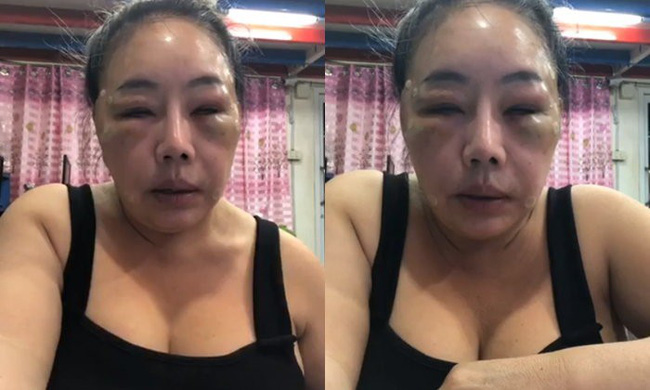 Nữ đại gia Thái Lan đổi chồng như thay áo năm nào gây sốc với gương mặt sưng vù vì bị chồng mới đánh đập?-1