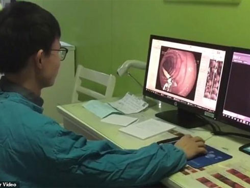 Đau bụng cả tháng tưởng bị dạ dày, người phụ nữ sốc nặng thấy thứ không tưởng này trong người-1