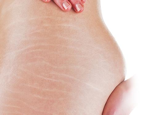 Rạn da đến mấy cũng mờ đi với công thức thần kỳ từ viên Vitamin E và nha đam-1