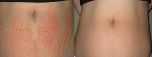 Rạn da đến mấy cũng mờ đi với công thức thần kỳ từ viên Vitamin E và nha đam-7