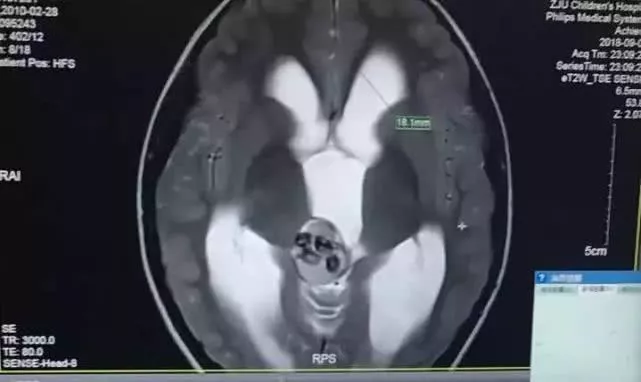 Cậu bé 5 tuổi bị đau đầu, nôn mửa, đi khám bác sĩ phát hiện có tới 9 chiếc răng trong não-1