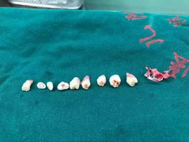 Cậu bé 5 tuổi bị đau đầu, nôn mửa, đi khám bác sĩ phát hiện có tới 9 chiếc răng trong não-2