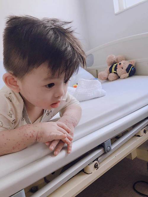 Ủ bệnh 10 ngày, bé trai 20 tháng được phát hiện mắc tay chân miệng nặng nhất bệnh viện-3