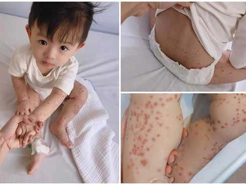 Ủ bệnh 10 ngày, bé trai 20 tháng được phát hiện mắc tay chân miệng nặng nhất bệnh viện