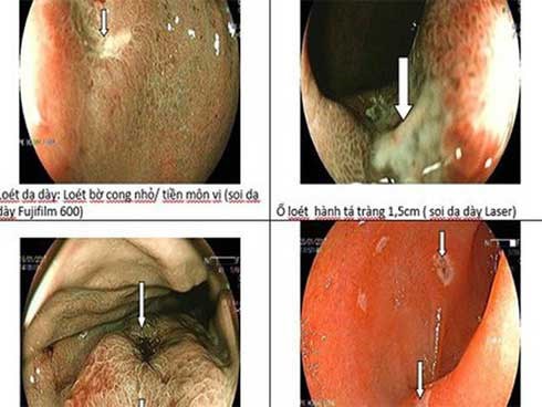 Chuyên gia tiêu hóa chỉ ra thủ phạm chính gây loét dạ dày