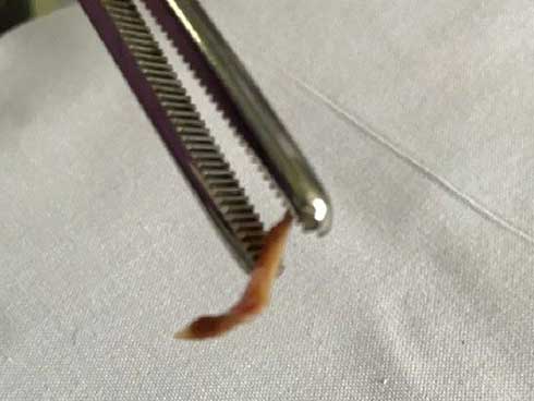 Bài học nhói lòng từ những ca trẻ hóc dị vật 2018: Bé sống thực vật, 11 tuổi mất mạng-5