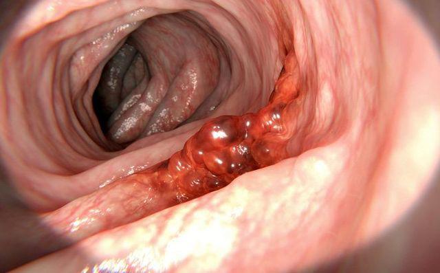 Người phụ nữ bị ung thư dạ dày giai đoạn cuối vì thói quen nấu nướng tai hại-3