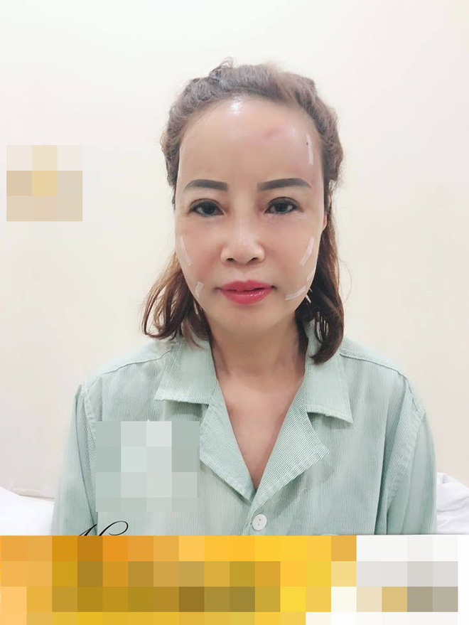 Cô dâu 62 tuổi tiến hành phẫu thuật thẩm mỹ, nhan sắc mới trẻ trung như ở tuổi 40-1