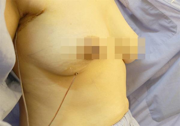 Phát hiện ngực có hòn khi tắm, đi khám người phụ nữ phát hiện mắc ung thư-1