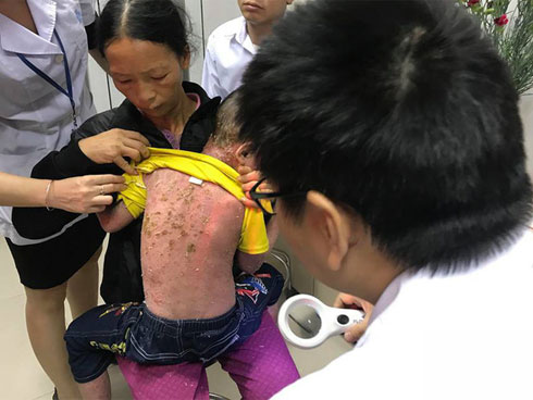 Bác sĩ Da liễu lý giải căn bệnh người cóc” của cậu bé Nùng khiến nhiều người sợ hãi-2