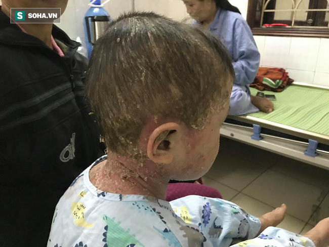 Bác sĩ Da liễu lý giải căn bệnh người cóc” của cậu bé Nùng khiến nhiều người sợ hãi-1