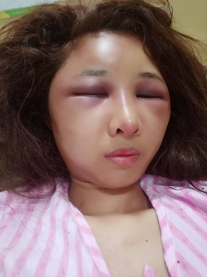 Sốc với gương mặt biến dạng trầm trọng của mẹ trẻ xinh đẹp bị chồng đánh vì trót để người yêu cũ đưa về nhà-3