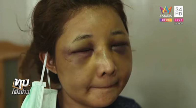 Sốc với gương mặt biến dạng trầm trọng của mẹ trẻ xinh đẹp bị chồng đánh vì trót để người yêu cũ đưa về nhà-4