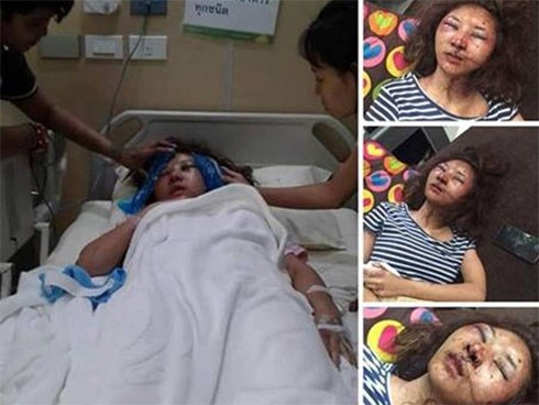 Sốc với gương mặt biến dạng trầm trọng của mẹ trẻ xinh đẹp bị chồng đánh vì trót để người yêu cũ đưa về nhà