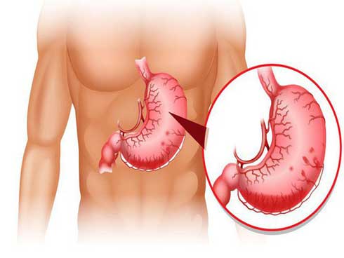 Viêm dạ dày lâu ngày có thể dẫn tới ung thư: Phát hiện và chữa kịp thời nhờ 8 dấu hiệu-1