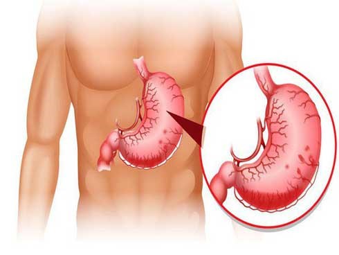Viêm dạ dày lâu ngày có thể dẫn tới ung thư: Phát hiện và chữa kịp thời nhờ 8 dấu hiệu