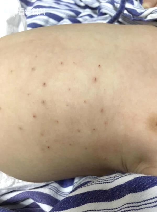 Làm theo mẹo dân gian, cha mẹ dùng kim châm liên tiếp quanh rốn bé mới sinh để dỗ con nín khóc-2