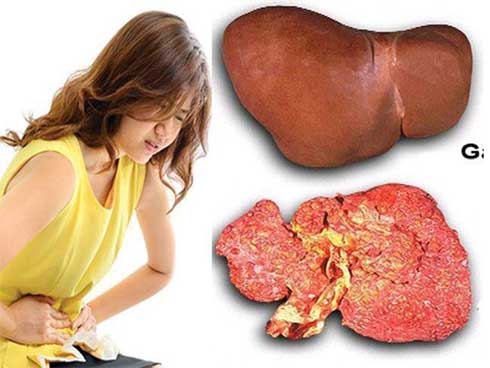 Bé 4 tuổi gan đã nhiễm mỡ vàng óng do ăn loại thức ăn quen thuộc-1