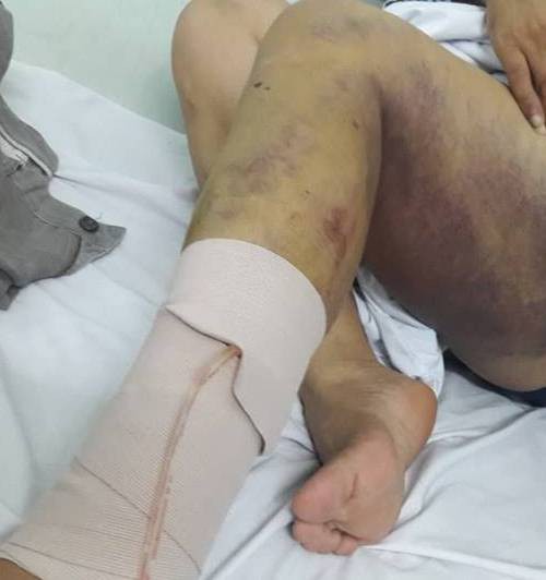 Người đàn ông kiệt quệ sau khi bị bạn gái thuê 5 côn đồ truy sát-7
