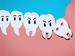 11 cách giúp bạn dịu cơn đau do mọc răng khôn-12