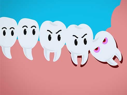 Sự tích răng khôn và vì sao chúng hành hạ con người đến vậy?