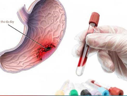 Các bước tầm soát ung thư dạ dày ai cũng cần biết