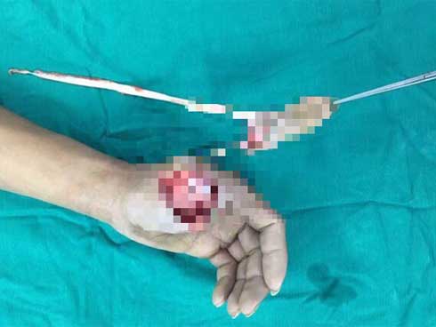 Nổ bình ga mini, nam thanh niên đứt rời ngón tay-1