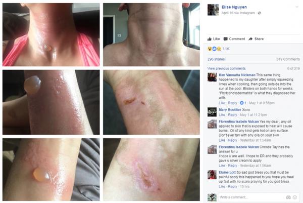 Hình ảnh cô gái bỏng nặng gây sốt MXH, nhiều người giật mình về thói quen giống như cô-1