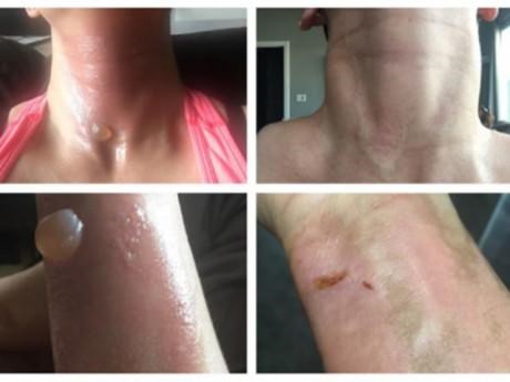 Hình ảnh cô gái bỏng nặng gây sốt MXH, nhiều người giật mình về thói quen giống như cô