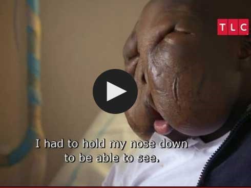 Bệnh ung thư cực hiếm khiến nam thanh niên 18 tuổi bị gọi là ‘quái vật’