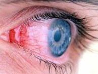 Những triệu chứng cảnh báo nguy cơ bệnh về mắt nguy hiểm