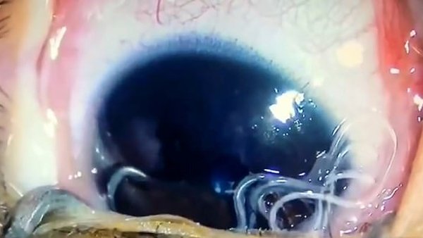 Bác sĩ kinh hãi gắp 11 con giun lúc nhúc trong mắt bé trai-1