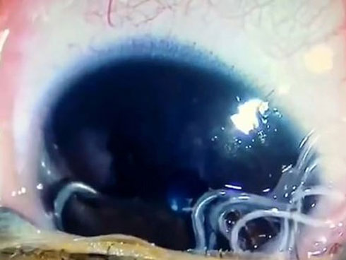 Bàn chân sưng to gấp 3 lần vì nhiễm giun sán khiến cô gái 21 tuổi có khả năng mất cả tương lai-6